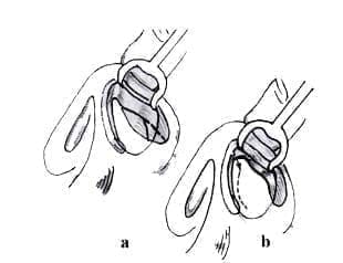 Vía Transcartilaginosa Vía Transcartilaginosa