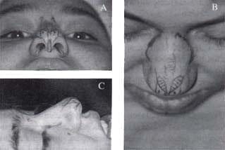 Marcada intraquirúrgica