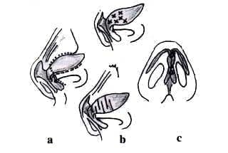 Colgajo Bipediculado Colgajo Bipediculado