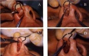 Incisión precartilaginosa o marginal