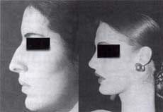 Rinoplastia primaria