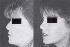 Rinoplastia secundaria