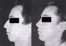 Rinoplastia en hombre