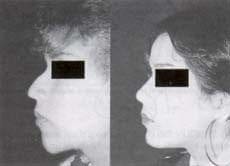 Rinoplastia terciaria