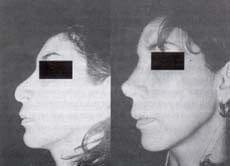 Rinoplastia más mentoplastia