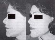 Rinoplastia secundaria más ritidoplastia Rinoplastia secundaria más ritidoplastia