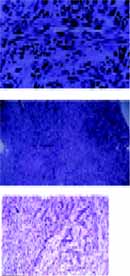 Diagnóstico de Rabdomiosarcoma Diagnóstico de Rabdomiosarcoma