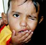 Parálisis fácil derecha Parálisis fácil derecha