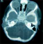 TAC Oído lección tejidos TAC Oído lección tejidos