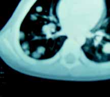 Metastasis Pulmonares Metastasis Pulmonares