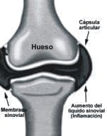 Anatomía de una Articulación. Sinovitis