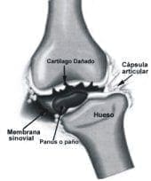 Anquilosis y Atrofia Muscular