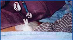 Catéter Central para Hemodiálisis Catéter Central para Hemodiálisis