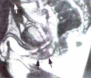 Fibrosis (flechas negras) del cuerpo esponjoso Fibrosis (flechas negras) del cuerpo esponjoso