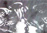 Separación del cuerpo cavernoso (cc) del isquium Separación del cuerpo cavernoso (cc) del isquium