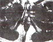 Fibrosis (flechas blancas) del cuerpo cavernoso izquierdo Fibrosis (flechas blancas) del cuerpo cavernoso izquierdo