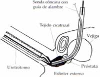 vu-113- Figura 13 Tratamiento de la estrecheces uretrales mediante láser de neodymium