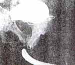 Uretrograma retrógrado con cistograma miccional Uretrograma retrógrado con cistograma miccional