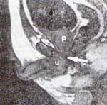 Plastía término-terminal por vía perineal Plastía término-terminal por vía perineal