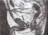 Elevación de la vejiga por agrandamiento prostático Elevación de la vejiga por agrandamiento prostático