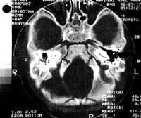 Tomografía Axial Computarizada de hueso temporal a nivel Epitímpano Tomografía Axial Computarizada de hueso temporal a nivel Epitímpano