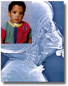 Aumento del diámetro subglótico durante el proceso de crecimiento del niño