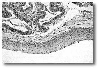 Adenoma Monocromo