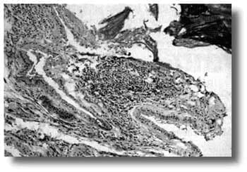 Microcirugía Endolaríngea Microcirugía Endolaríngea