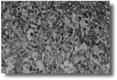 Muestra la positividad de las células linfoides al CD 20