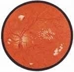 Historia de la Diabetes Historia de la Diabetes