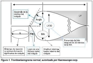 Troboelastograma normal