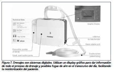 Drenaje con sistemas digitales, Esternotomía Drenaje con sistemas digitales, Esternotomía
