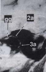 Imagen semisagital que permite la identificación por supuesto del canal del facial Imagen semisagital que permite la identificación por supuesto del canal del facial