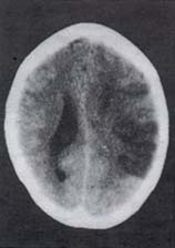 TC que muestra un infarto agudo parietal izquierdo TC que muestra un infarto agudo parietal izquierdo