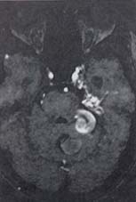 Extensa malformación arterio-venosa Extensa malformación arterio-venosa