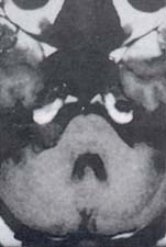 Neurinoma intracanalicular con extensión a la cisterna pontocerebelosa derecha Neurinoma intracanalicular con extensión a la cisterna pontocerebelosa derecha