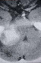 TC, Meningioma del ángulo pontocerebeloso derecho TC, Meningioma del ángulo pontocerebeloso derecho