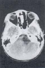 Lesión congénita Lesión congénita