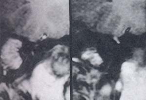 Pequeño neurinoma del nervio facial Pequeño neurinoma del nervio facial