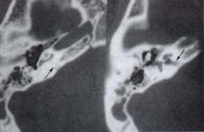 Parálisis del facial Parálisis del facial