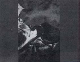 Muestra de un realce lineal y regular del nervio facial (a)