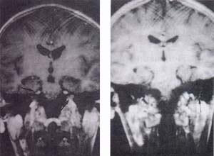 Captación anormal del contraste paramagnético por infiltración leptomeníngea 