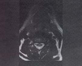 Lesión del N. facial intraparotidea Lesión del N. facial intraparotidea