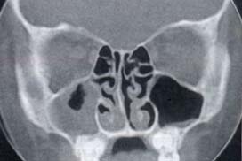 Desviación septal por un cornete medio paradójico Desviación septal por un cornete medio paradójico