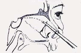 Osteotomía de la lámina perpendicular con cincel de doble guarda Osteotomía de la lámina perpendicular con cincel de doble guarda