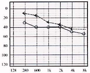 Hipoacusia mixta moderada secuela de OME Hipoacusia mixta moderada secuela de OME