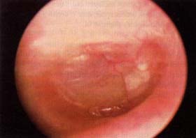 Otitis con efusión miríngoesclerosis asociada