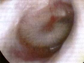 Otitis con lìquido retrotimpánico