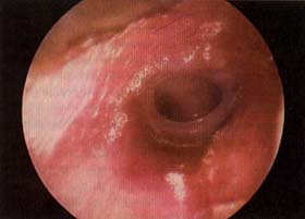 Perforación timpánica y hongos