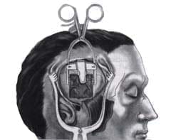 Elevación de la duramadre y el lóbulo temporal Elevación de la duramadre y el lóbulo temporal